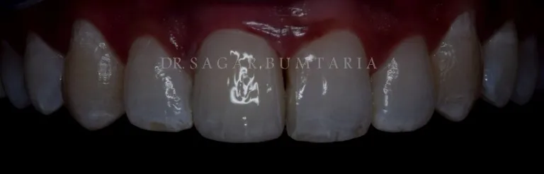 Artificial teeth and denture treatment at Nijanand Dental Clinic Jamnagar