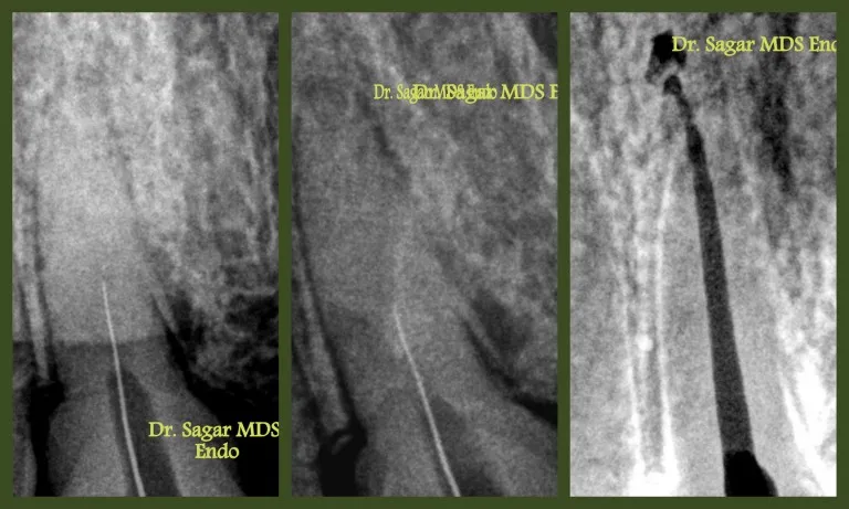 Calcified root canal treatment procedure by dentist in Jamnagar