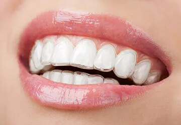 Clear Braces and Invisible Aligners in Jamnagar