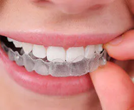 Clear ceramic braces for teeth alignment in Jamnagar