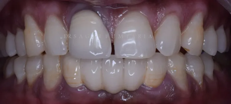Cosmetic dentistry treatment results at Jamnagar dental clinic