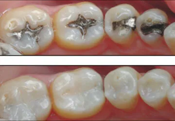 Cosmetic Tooth Filling Procedure in Jamnagar