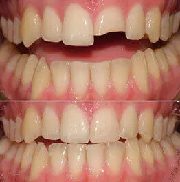 Dentist performing cosmetic tooth filling procedure in Jamnagar