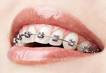 Dental Braces and Orthodontic Treatment in Jamnagar