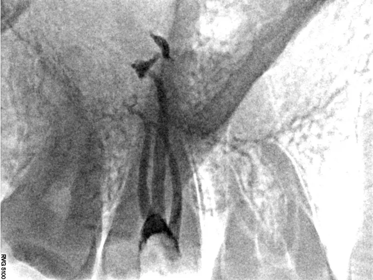 Dental procedure performed by experienced dentist in Jamnagar