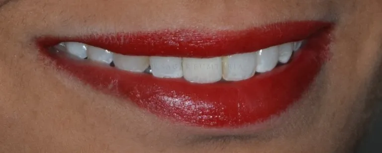 Dental treatment result showcase at Nijanand Dental Clinic Jamnagar