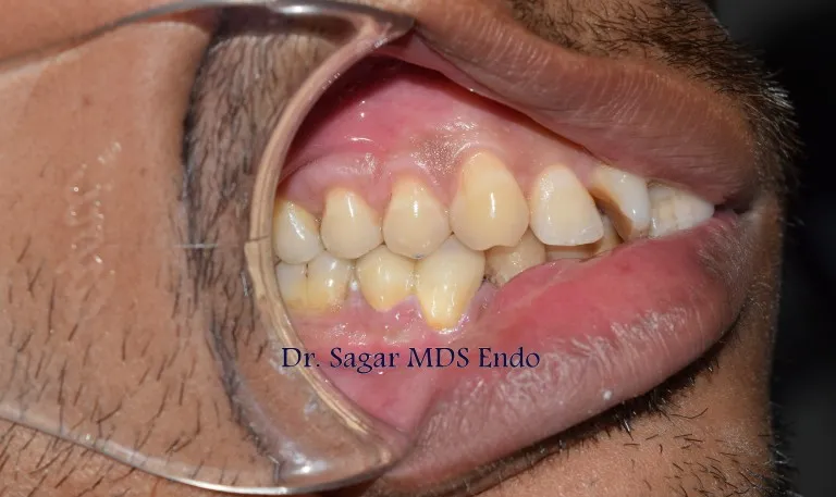 Dental treatment procedure at Nijanand Dental Clinic in Jamnagar