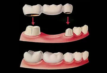 Dental Crowns and Bridges Treatment in Jamnagar