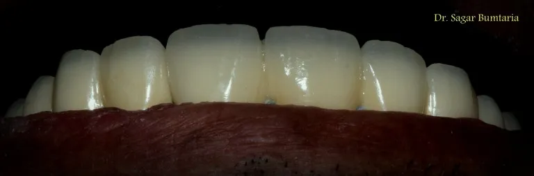 Dental smile transformation result at Nijanand Dental Clinic Jamnagar