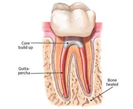 Dental root canal therapy at Nijanand Dental Clinic Jamnagar