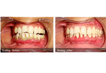 Dental Scaling and Teeth Polishing in Jamnagar