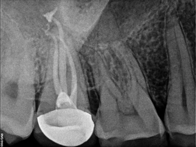 Successful dental treatment result at dental clinic in Jamnagar