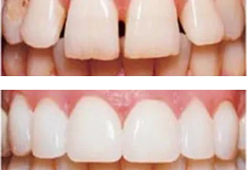 Dental Veneers and Laminates Treatment in Jamnagar