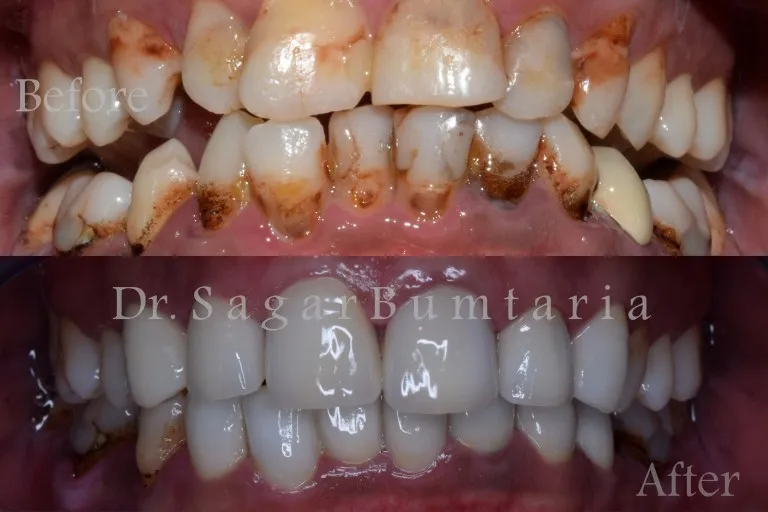 E-max porcelain dental crown restoration treatment in Jamnagar