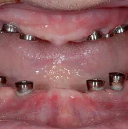 Full Mouth Dental Implants Treatment in Jamnagar