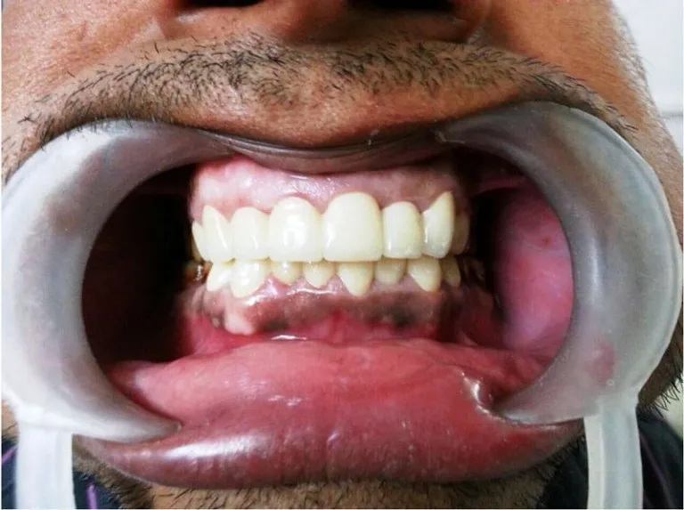 Full mouth PFM dental bridge procedure at Nijanand Dental Clinic Jamnagar
