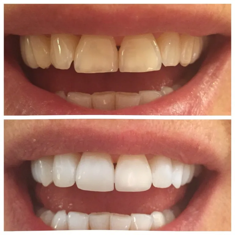 Full mouth PFM restoration case study photo at Nijanand Dental Clinic Jamnagar