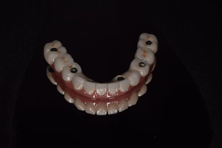 Full Mouth Rehabilitation Patient Result Case 10 Nijanand Dental Clinic Jamnagar