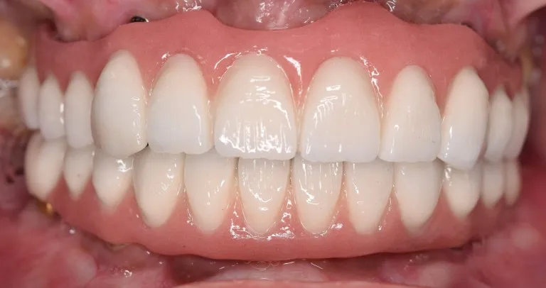 Full Mouth Rehabilitation Result Photo Case 6 Nijanand Dental Clinic Jamnagar
