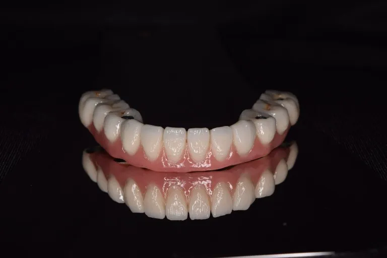 Full Mouth Rehabilitation Dental Restoration Case 9 Nijanand Dental Clinic Jamnagar
