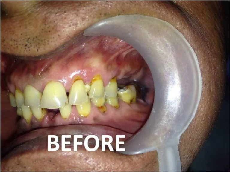 Full mouth zirconia crowns dental restoration result at Nijanand Dental Clinic Jamnagar