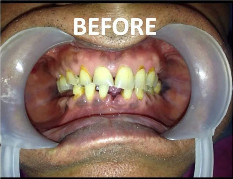 Full mouth zirconia dental rehabilitation case at Nijanand Dental Clinic Jamnagar