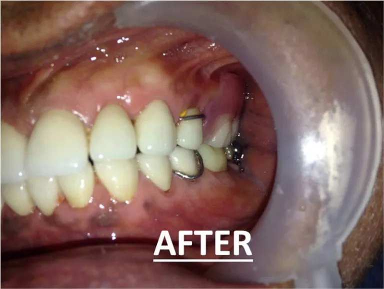 Before and after full mouth zirconia dental treatment at Nijanand Dental Clinic Jamnagar