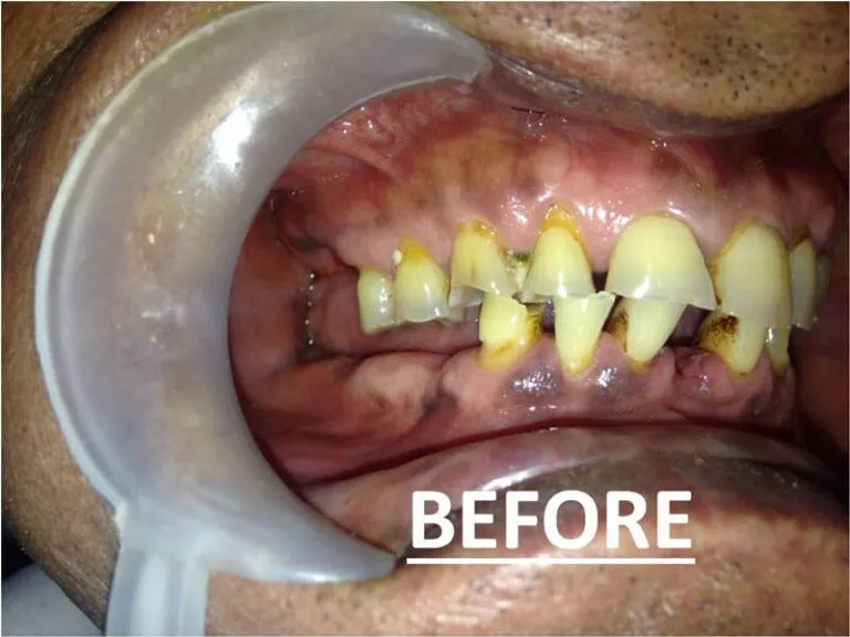 Full mouth zirconia dental prosthesis procedure at Nijanand Dental Clinic Jamnagar