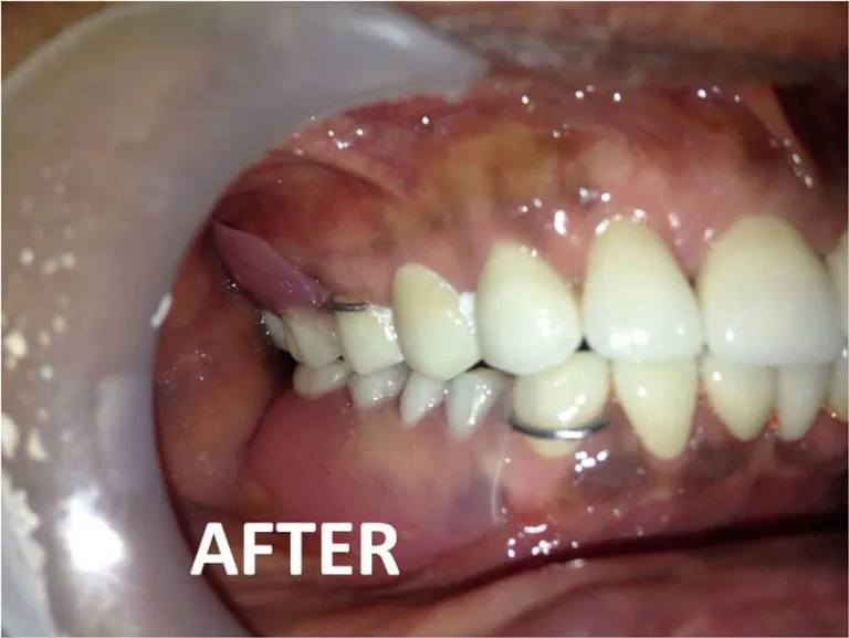 Smile transformation using full mouth zirconia bridge at Nijanand Dental Clinic Jamnagar