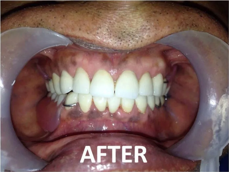 Full mouth zirconia teeth replacement treatment at Nijanand Dental Clinic Jamnagar