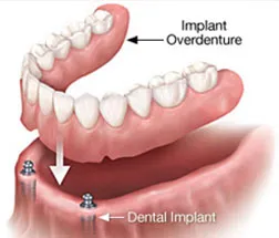Implant Supported Dentures Treatment in Jamnagar