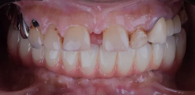 Intraoral lower full mouth dental examination case in Jamnagar