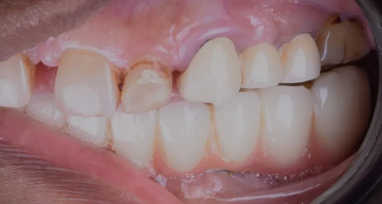 Left bite intraoral view dental treatment case in Jamnagar