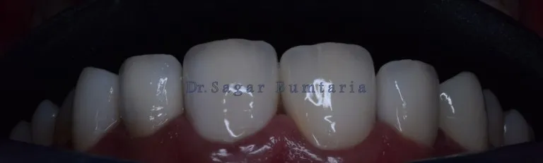 Lifelike artificial teeth and natural looking dental prosthetics in Jamnagar
