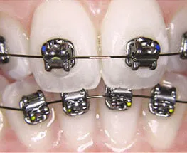 Metal Braces Orthodontic Procedure at Nijanand Dental Clinic