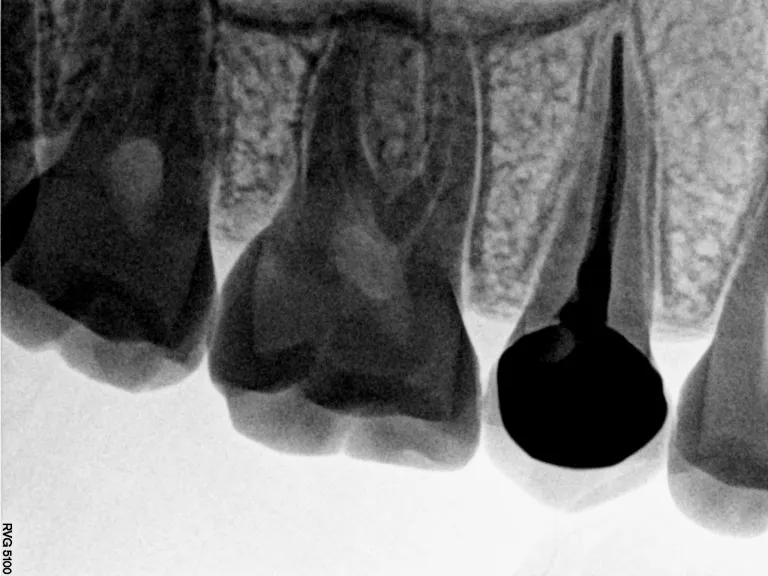 Painless root canal treatment demonstration at Nijanand Dental Clinic