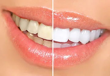 Professional Teeth Whitening Service in Jamnagar