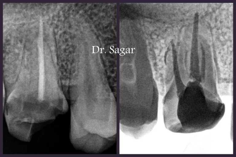 Re-root canal treatment procedure result in Jamnagar