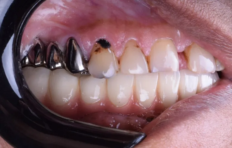 Right bite intraoral view dental treatment case in Jamnagar