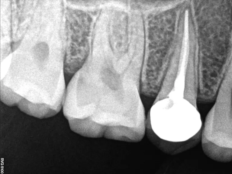 Root canal treatment before and after case in Jamnagar
