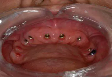 Single Tooth Dental Implant Procedure in Jamnagar