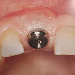Single Tooth Dental Implant Result at Nijanand Dental Clinic