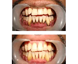Teeth Polishing and Plaque Removal Treatment in Jamnagar