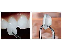 Tooth Preparation for Dental Veneers and Laminates