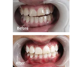 Before and after tooth whitening treatment at Nijanand Dental Clinic