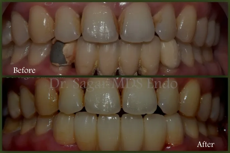 Zirconia crown dental restoration procedure in Jamnagar